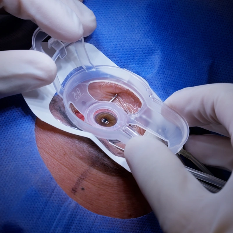 Trasplante de Córnea